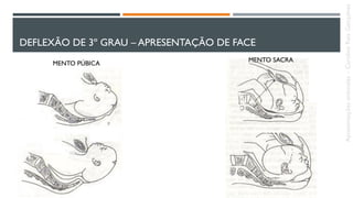 DEFLEXÃO DE 3º GRAU – APRESENTAÇÃO DE FACE
MENTO PÚBICA
MENTO SACRA
Apresentaçõesanômalas–CarolineReisGonçalves
 
