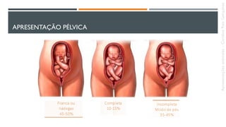 APRESENTAÇÃO PÉLVICA
Apresentaçõesanômalas–CarolineReisGonçalves
 
