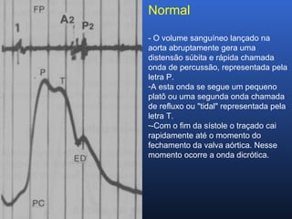 Normal
- O volume sanguíneo lançado na
aorta abruptamente gera uma
distensão súbita e rápida chamada
onda de percussão, representada pela
letra P.
-A esta onda se segue um pequeno
platô ou uma segunda onda chamada
de refluxo ou "tidal" representada pela
letra T.
--Com o fim da sístole o traçado cai
rapidamente até o momento do
fechamento da valva aórtica. Nesse
momento ocorre a onda dicrótica.
 