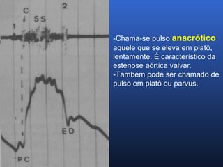 -Chama-se pulso anacrótico
aquele que se eleva em platô,
lentamente. É característico da
estenose aórtica valvar.
-Também pode ser chamado de
pulso em platô ou parvus.
 