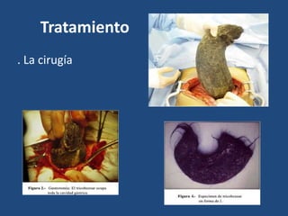 Tratamiento
. La cirugía