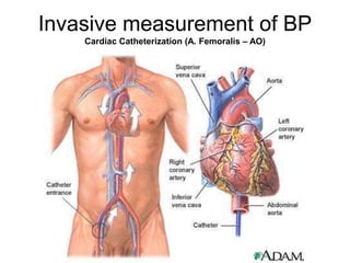 Invasive measurement of BP
Cardiac Catheterization (A. Femoralis – AO)
 