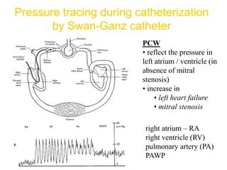 Pressure tracing during catheterization
by Swan-Ganz catheter
right atrium – RA
right ventricle (RV)
pulmonary artery (PA)
PAWP
PCW
• reflect the pressure in
left atrium / ventricle (in
absence of mitral
stenosis)
• increase in
• left heart failure
• mitral stenosis
 