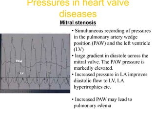 Pressures in heart valve
diseases
Mitral stenosis
• Simultaneous recording of pressures
in the pulmonary artery wedge
position (PAW) and the left ventricle
(LV)
• large gradient in diastole across the
mitral valve. The PAW pressure is
markedly elevated.
• Increased pressure in LA improves
diastolic flow to LV, LA
hypertrophies etc.
• Increased PAW may lead to
pulmonary edema
 
