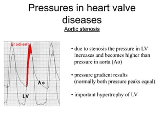 • due to stenosis the pressure in LV
increases and becomes higher than
pressure in aorta (Ao)
• pressure gradient results
(normally both pressure peaks equal)
• important hypertrophy of LV
Pressures in heart valve
diseases
Aortic stenosis
 