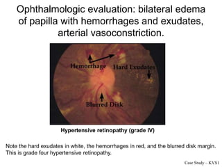 Ophthalmologic evaluation: bilateral edema
of papilla with hemorrhages and exudates,
arterial vasoconstriction.
Note the hard exudates in white, the hemorrhages in red, and the blurred disk margin.
This is grade four hypertensive retinopathy.
Hypertensive retinopathy (grade IV)
Case Study – KVS1
 