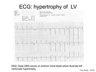 ECG: hypertrophy of LV
EKG: Deep QRS waves on anterior chest leads which illustrate left
ventricular hypertrophy Case Study – KVS1
 