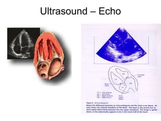 Ultrasound – Echo
 