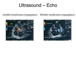 Aortální insuficience (regurgitace) Mitrální insuficience (regurgitace)
Ultrasound – Echo
 