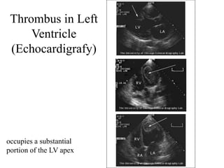 Thrombus in Left
Ventricle
(Echocardigrafy)
occupies a substantial
portion of the LV apex
 