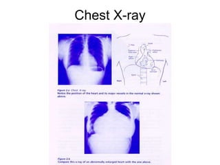 Chest X-ray
 