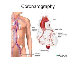 Coronarography
 