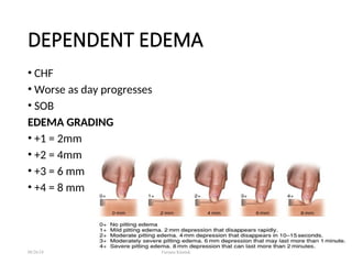 DEPENDENT EDEMA
• CHF
• Worse as day progresses
• SOB
EDEMA GRADING
• +1 = 2mm
• +2 = 4mm
• +3 = 6 mm
• +4 = 8 mm
08/26/24 Farzana Khattak
 
