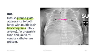 Air Bronchogram Rds 3-Complication of prematurity.pdf DRMjkk | PDF