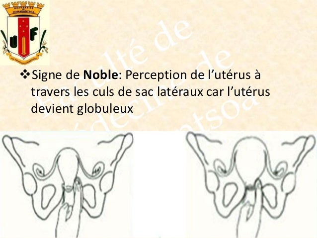 Decouverte Tardive De Grossesse Car Regles Diagnostic de grossesse au 1er trimestre