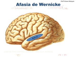 Afasia de Wernicke
Profª Viviane Marques
LESÃO NO GIRO TEMPORAL SUPERIOR – ÁREA 22 DE WERNICKE
 