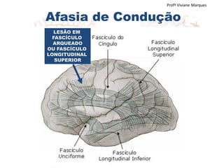 Afasia de Condução
Profª Viviane Marques
LESÃO EM
FASCÍCULO
ARQUEADO
OU FASCÍCULO
LONGITUDINAL
SUPERIOR
 
