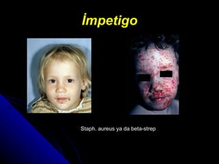 İmpetigo Staph. aureus  ya da  beta-strep  
