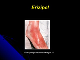 Erizipel Strep pyogenes- demarkasyon !!! 