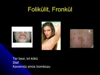 Folikülit, Fronkül Ter bezi, kıl kökü Staf Kavernöz sinüs trombozu 