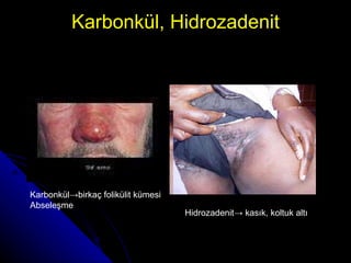 Karbonkül, Hidrozadenit Karbonkül ->birkaç folikülit kümesi Abseleşme Hidrozadenit -> kasık, koltuk altı 