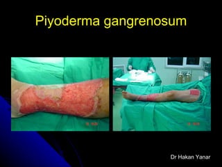 Piyoderma gangrenosum Dr Hakan Yanar 