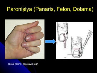 Paronişiya (Panaris, Felon, Dolama) Distal falanx, zonklayıcı ağrı 