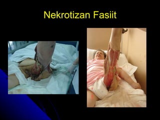 Nekrotizan Fasiit 
