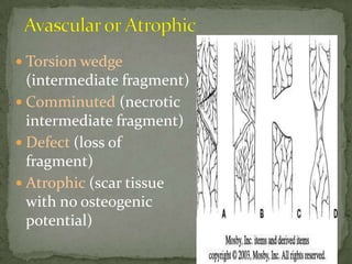 Avascular or AtrophicTorsion wedge (intermediate fragment)Comminuted (necrotic intermediate fragment)Defect (loss of fragment)Atrophic (scar tissue with no osteogenic potential)