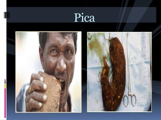 Eating Disorders | PPTX
