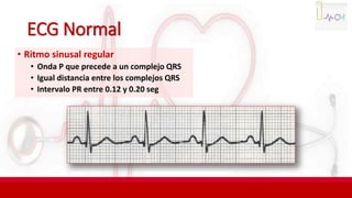 ECG Normal
• Ritmo sinusal regular
• Onda P que precede a un complejo QRS
• Igual distancia entre los complejos QRS
• Intervalo PR entre 0.12 y 0.20 seg
 