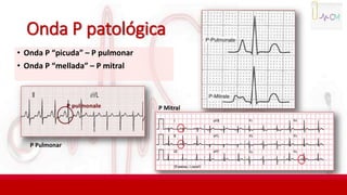 Onda P patológica
• Onda P “picuda” – P pulmonar
• Onda P “mellada” – P mitral
P Pulmonar
P Mitral
 