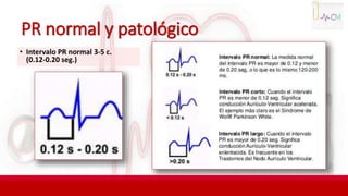 PR normal y patológico
• Intervalo PR normal 3-5 c.
(0.12-0.20 seg.)
 