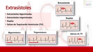 Extrasístoles
• Extrasístoles bigeminadas
• Extrasístoles trigeminadas
• Duplas
• Salvas de Taquicardia Ventricular (TV)
 