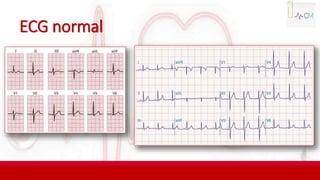 ECG normal
 