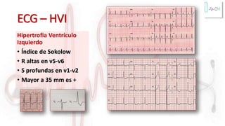 ECG – HVI
Hipertrofia Ventrículo
Izquierdo
• Índice de Sokolow
• R altas en v5-v6
• S profundas en v1-v2
• Mayor a 35 mm es +
 