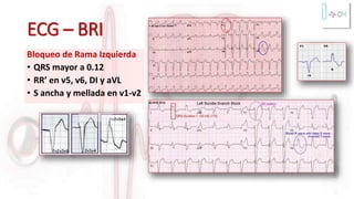 ECG – BRI
Bloqueo de Rama Izquierda
• QRS mayor a 0.12
• RR’ en v5, v6, DI y aVL
• S ancha y mellada en v1-v2
 