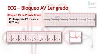 ECG – Bloqueo AV 1er grado
Bloqueo AV de Primer Grado
• Prolongación PR mayor a
0.20 seg
 