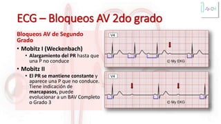 ECG – Bloqueos AV 2do grado
Bloqueos AV de Segundo
Grado
• Mobitz I (Weckenbach)
• Alargamiento del PR hasta que
una P no conduce
• Mobitz II
• El PR se mantiene constante y
aparece una P que no conduce.
Tiene indicación de
marcapasos, puede
evolucionar a un BAV Completo
o Grado 3
 