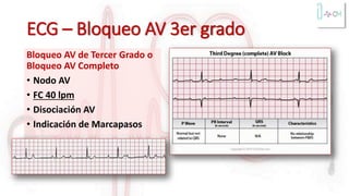 ECG – Bloqueo AV 3er grado
Bloqueo AV de Tercer Grado o
Bloqueo AV Completo
• Nodo AV
• FC 40 lpm
• Disociación AV
• Indicación de Marcapasos
 