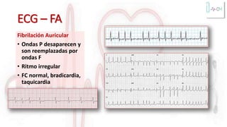 ECG – FA
Fibrilación Auricular
• Ondas P desaparecen y
son reemplazadas por
ondas F
• Ritmo irregular
• FC normal, bradicardia,
taquicardia
 