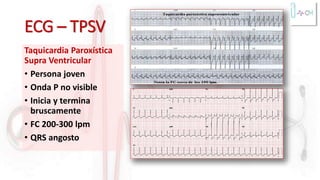 ECG – TPSV
Taquicardia Paroxística
Supra Ventricular
• Persona joven
• Onda P no visible
• Inicia y termina
bruscamente
• FC 200-300 lpm
• QRS angosto
 