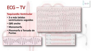 ECG – TV
Taquicardia Ventricular
• 3 o más latidos
ventriculares seguidos
• QRS ancho
• Monomorfa
• Pleomorfa o Torsada de
Puntas
 