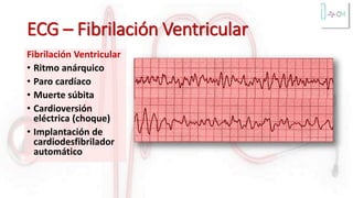 ECG – Fibrilación Ventricular
Fibrilación Ventricular
• Ritmo anárquico
• Paro cardíaco
• Muerte súbita
• Cardioversión
eléctrica (choque)
• Implantación de
cardiodesfibrilador
automático
 