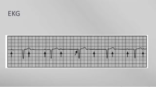 3   ecg