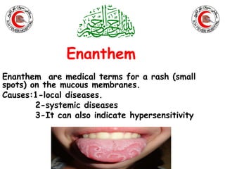 Enanthem 
Enanthem are medical terms for a rash (small 
spots) on the mucous membranes. 
Causes:1-local diseases. 
2-systemic diseases 
3-It can also indicate hypersensitivity 
 