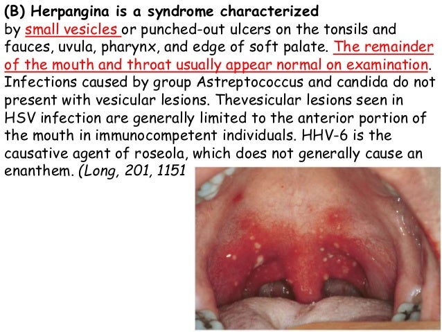 Herpangina In Adults Herpangina In Adults