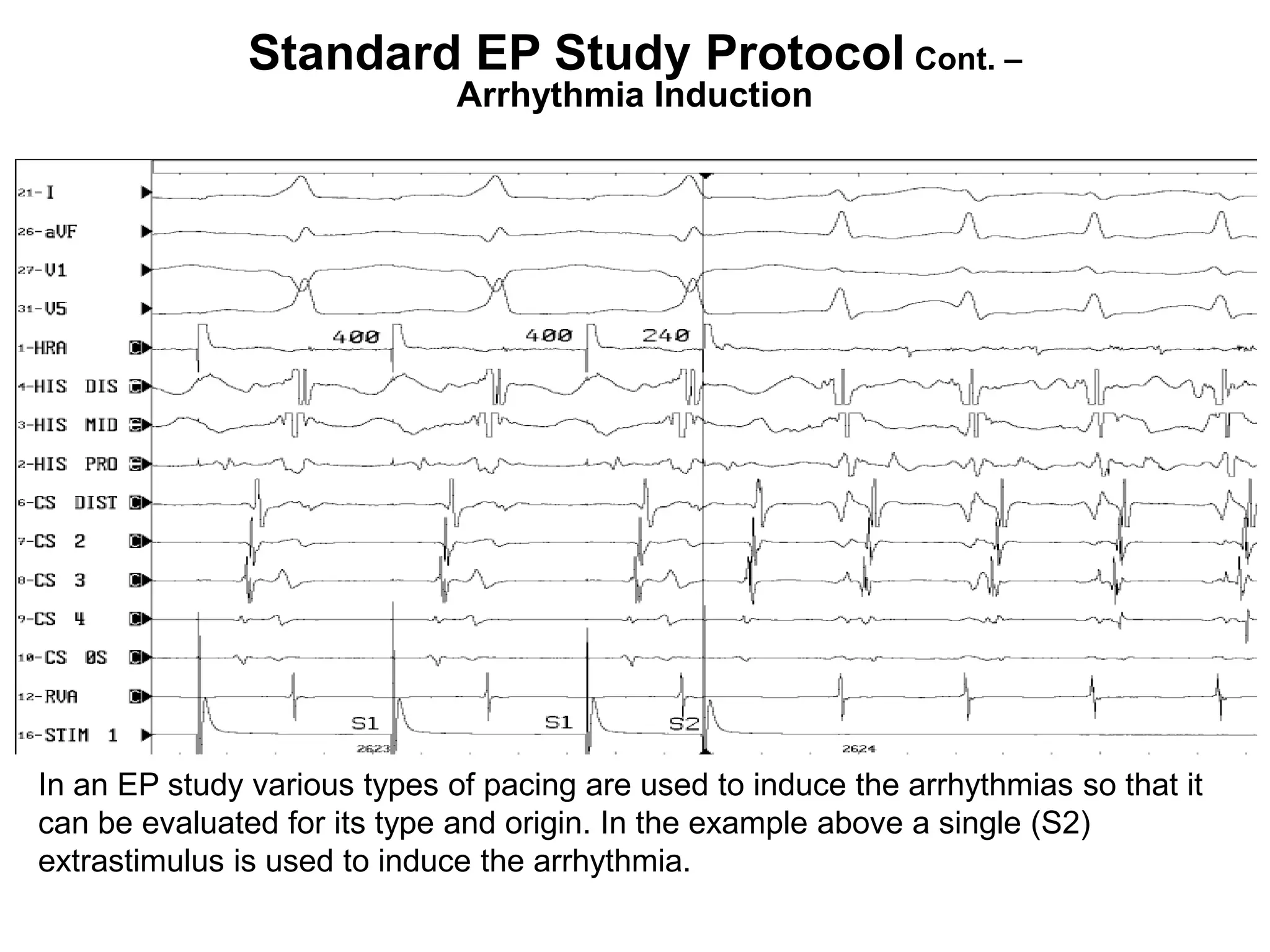 Standard EP Study Protocol Cont. –
                              Arrhythmia Induction




In an EP study various types of pacing are used to induce the arrhythmias so that it
can be evaluated for its type and origin. In the example above a single (S2)
extrastimulus is used to induce the arrhythmia.
103
 