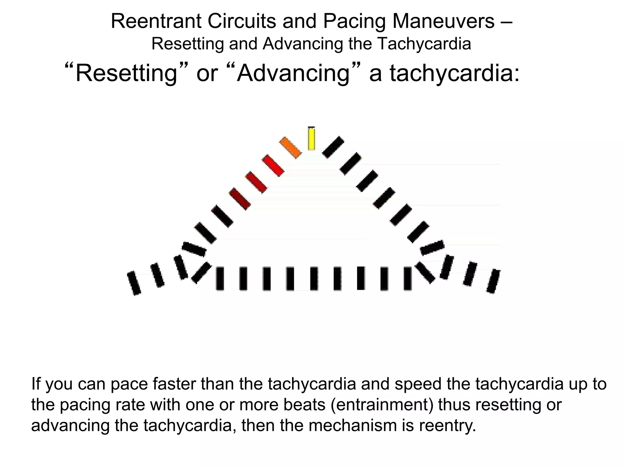 Reentrant Circuits and Pacing Maneuvers –
                Resetting and Advancing the Tachycardia
      “Resetting” or “Advancing” a tachycardia:




 If you can pace faster than the tachycardia and speed the tachycardia up to
 the pacing rate with one or more beats (entrainment) thus resetting or
 advancing the tachycardia, then the mechanism is reentry.
111
 