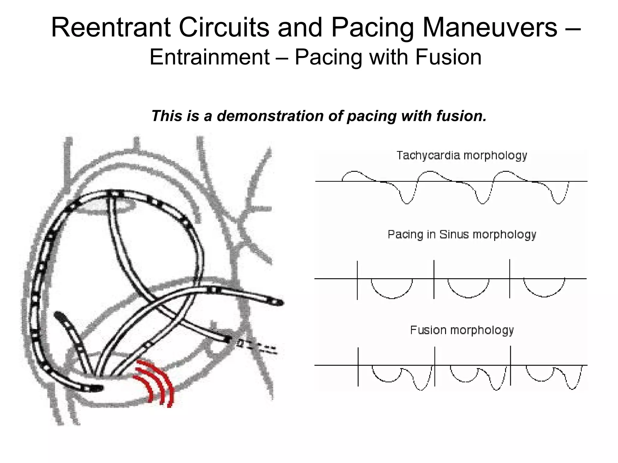 Reentrant Circuits and Pacing Maneuvers –
             Entrainment – Pacing with Fusion

             This is a demonstration of pacing with fusion.




115
 